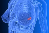 Les lasers et les ultrasons permettent un diagnostic plus rapide du cancer du sein