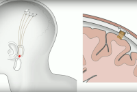 Neuralink : comment Elon Musk veut faire de vous des humains augmentés