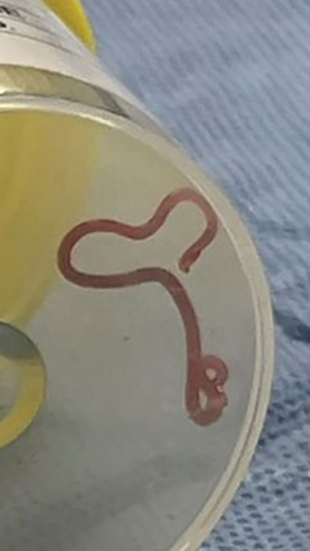  Un ver vivant de 8 centimètres retiré du cerveau d’une femme, en Australie