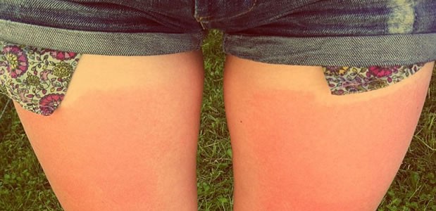 sunburn coup de soleil short jean