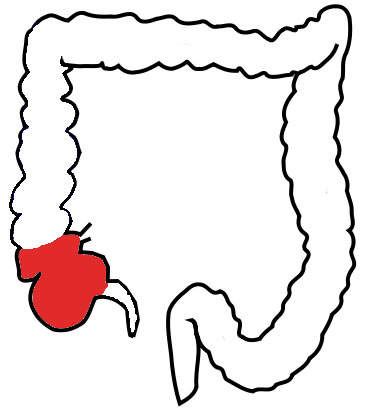 histoire-preservatif-colon