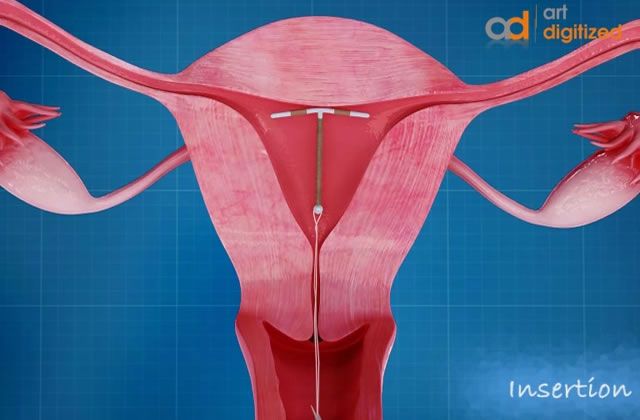 Le Diu Sterilet Parlons Contraception Madmoizelle