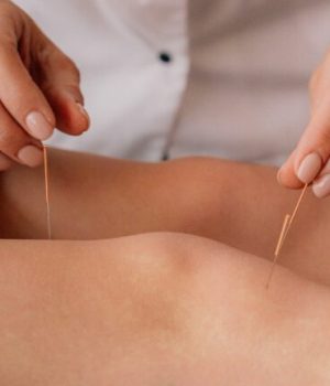 Acupuncture sur les jambes d'une femme