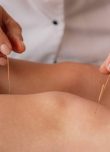 Acupuncture sur les jambes d'une femme