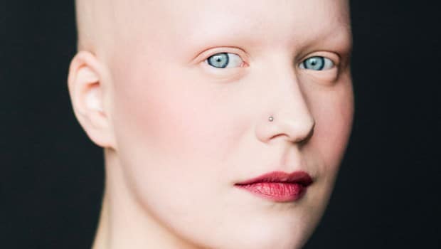 femmes-chauves-alopecie
