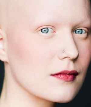femmes-chauves-alopecie