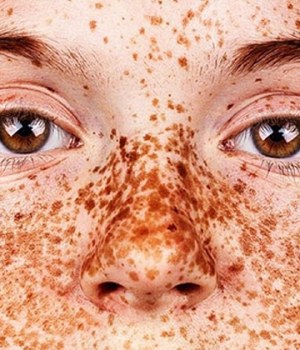 photos-taches-rousseur-freckles