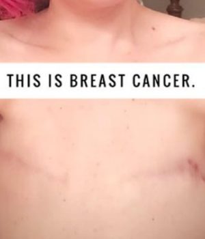 cancer-du-sein-temoignage