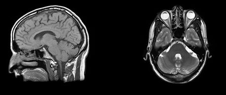 scanner-cerveau scanner-cerveau