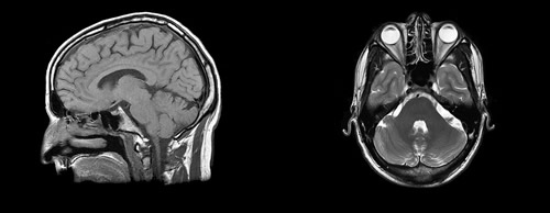 scanner-cerveau