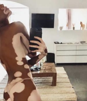 winnie-harlow-mannequin-vitiligo