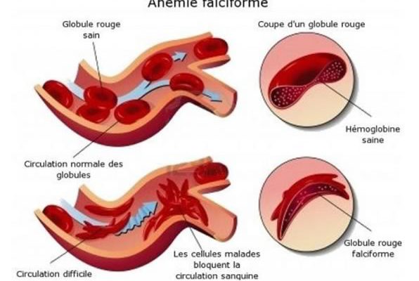 drepanocytose globules rouges drepacare drepanocytose globules rouges drepacare