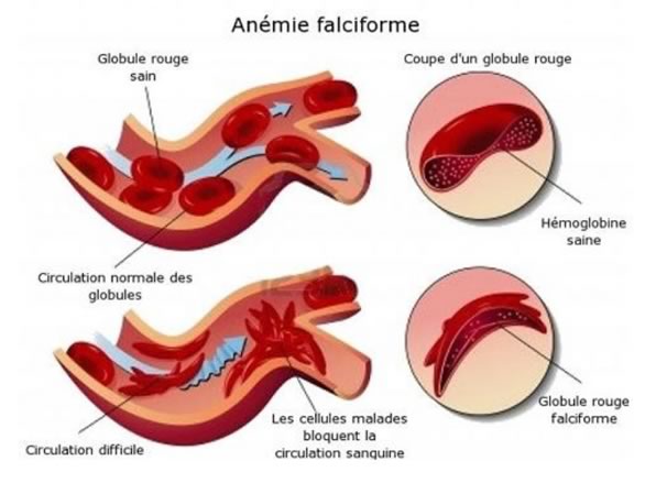 drepanocytose globules rouges