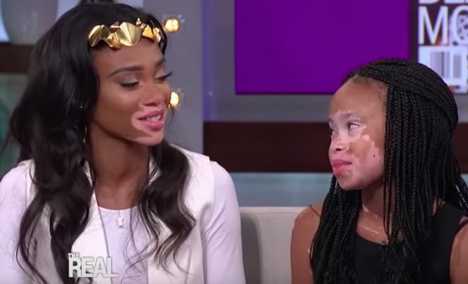 Winnie Harlow Winnie Harlow