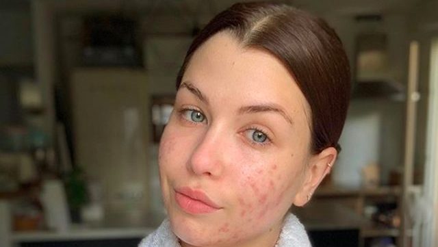 EnjoyPhoenix se livre sur son combat contre l'acné hormonale en vidéo