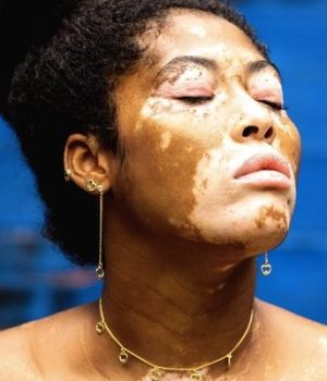 vitiligo-temoignages vitiligo-temoignages
