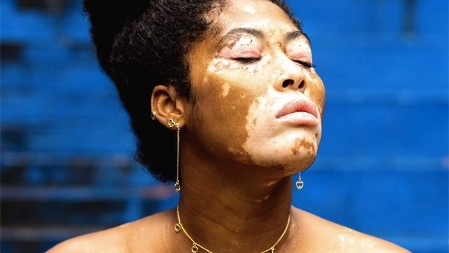 vitiligo-temoignages