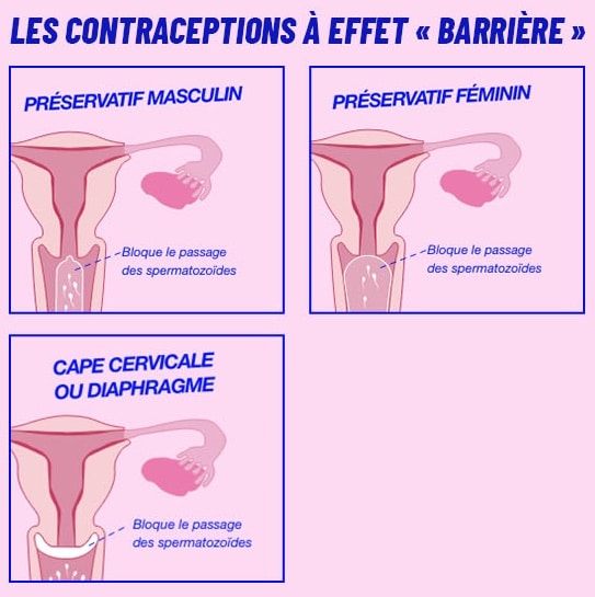 contraceptions-barriere