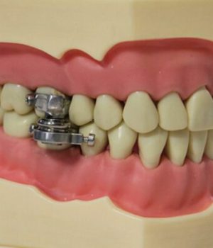DentalSlim Diet Control DentalSlim Diet Control
