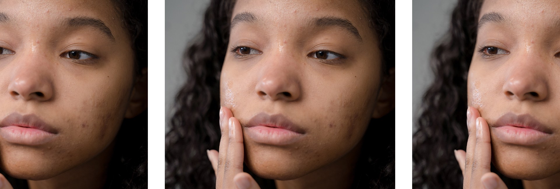 Acne 5 Astuces Pour Eliminer Silencieusement Un Bouton Pendant La Nuit