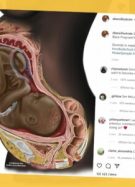 illustration médicale d'une femme noire enceinte