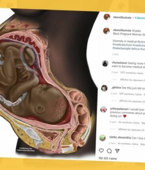 illustration médicale d'une femme noire enceinte