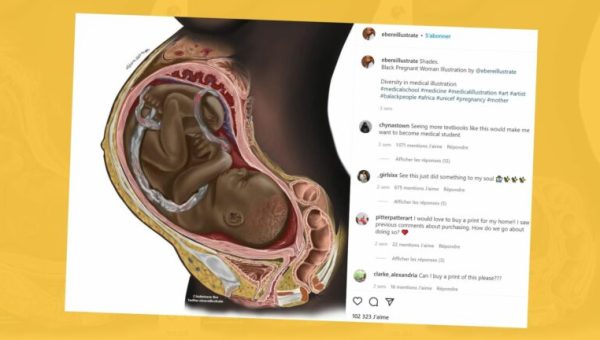 illustration médicale d'une femme noire enceinte