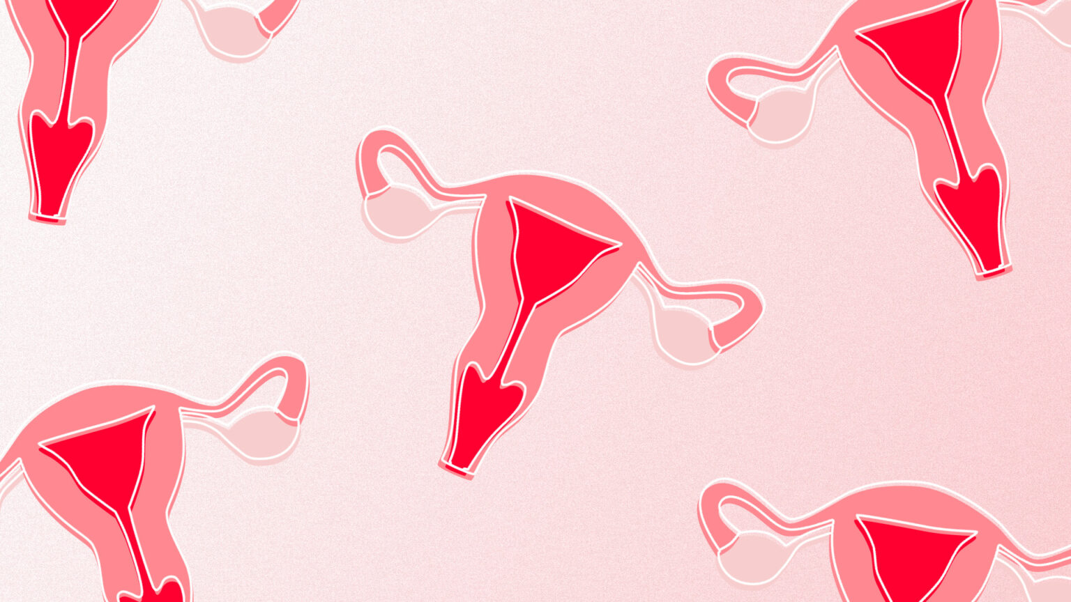 Endometriose_1_H Endometriose_1_H