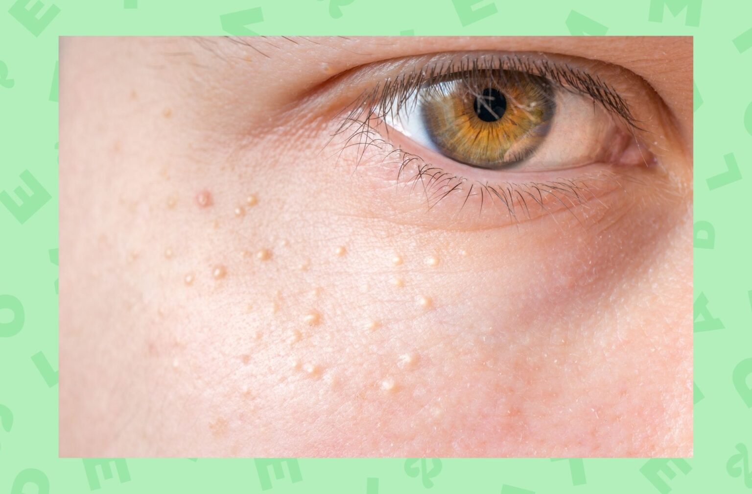 Voici à quoi ressemble des grains de milium sur la peau du contour des yeux. Voici à quoi ressemble des grains de milium sur la peau du contour des yeux.