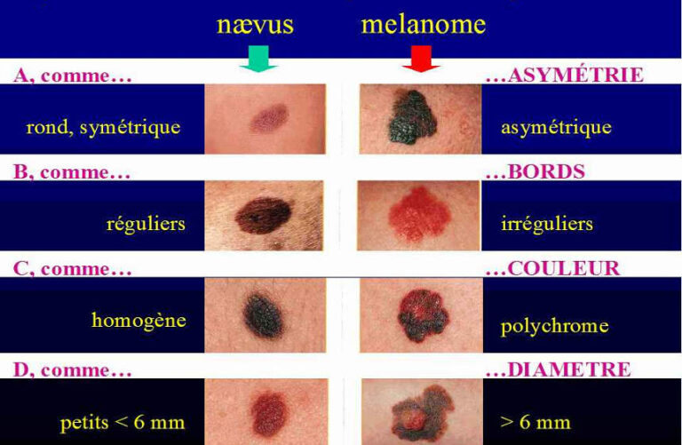 Méthode-ABCDE-cancer-de-peau Méthode-ABCDE-cancer-de-peau