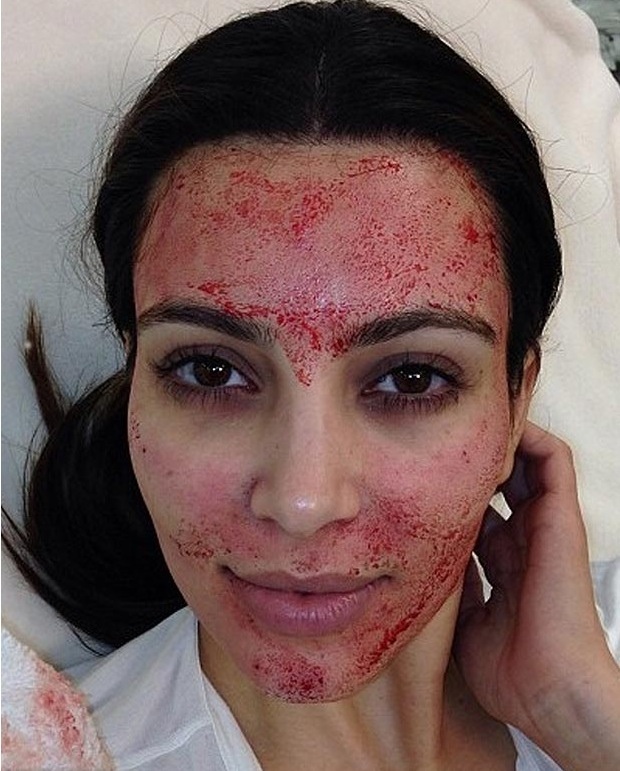 kim kardashian vampire face lift