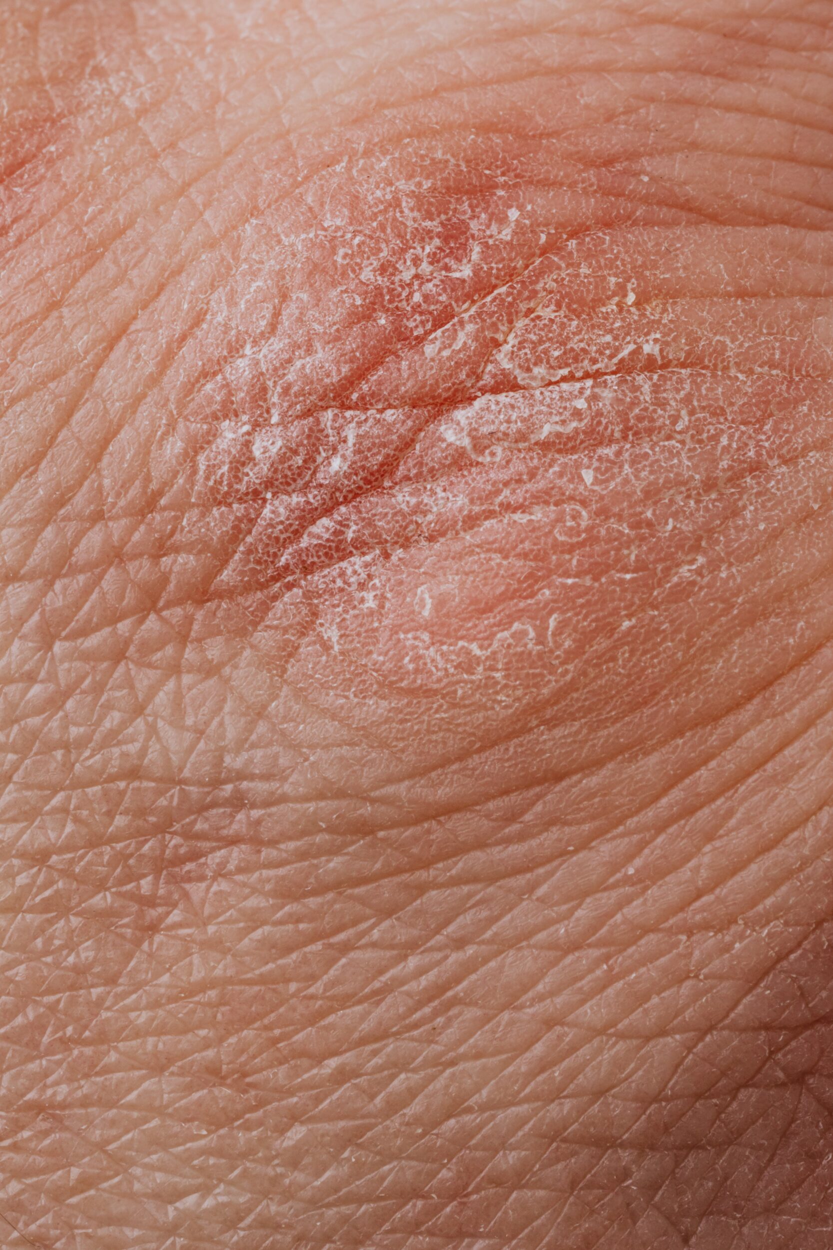 maladie-peau-psoriasis maladie-peau-psoriasis