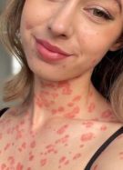 psoriasis-causes-traitements