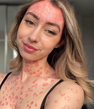 psoriasis-maladie-peau