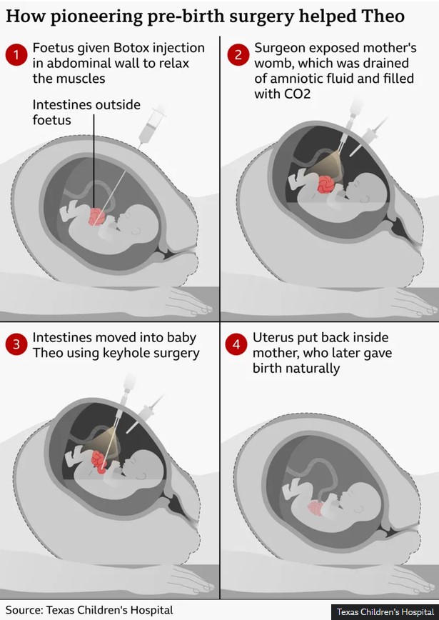 operation chirurgical intra uterin