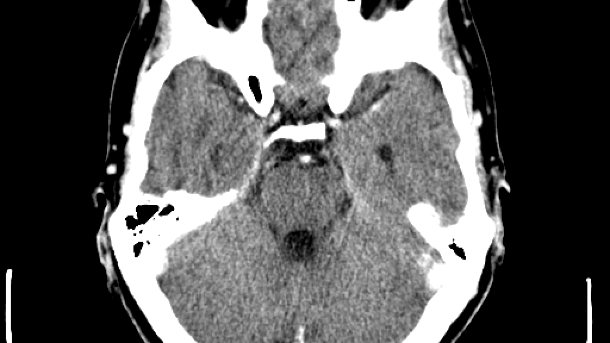 computed_tomography_of_brain.png