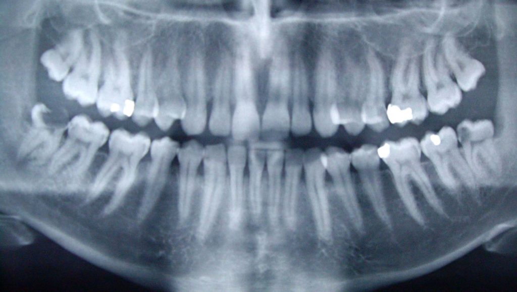 radio-dent-dentition-machoire