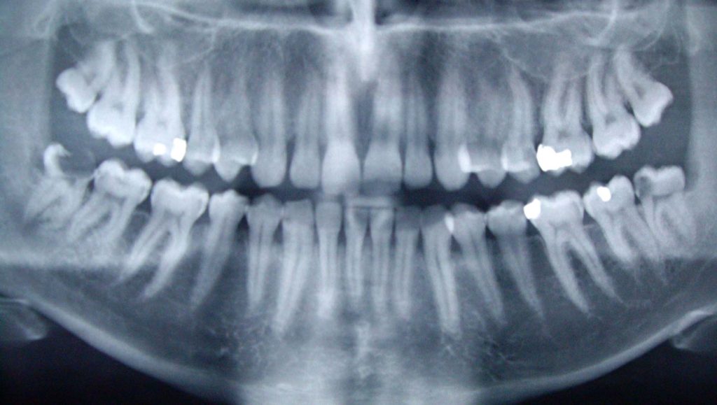 radio-dent-dentition-machoire radio-dent-dentition-machoire
