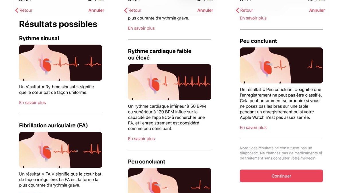 Résultats possibles avec un électrocardiogramme // Source : Numerama