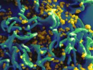 Une cellule infectée par le VIH. // Source : Wikimedia/CC/National Institutes of Health (photo recadrée)