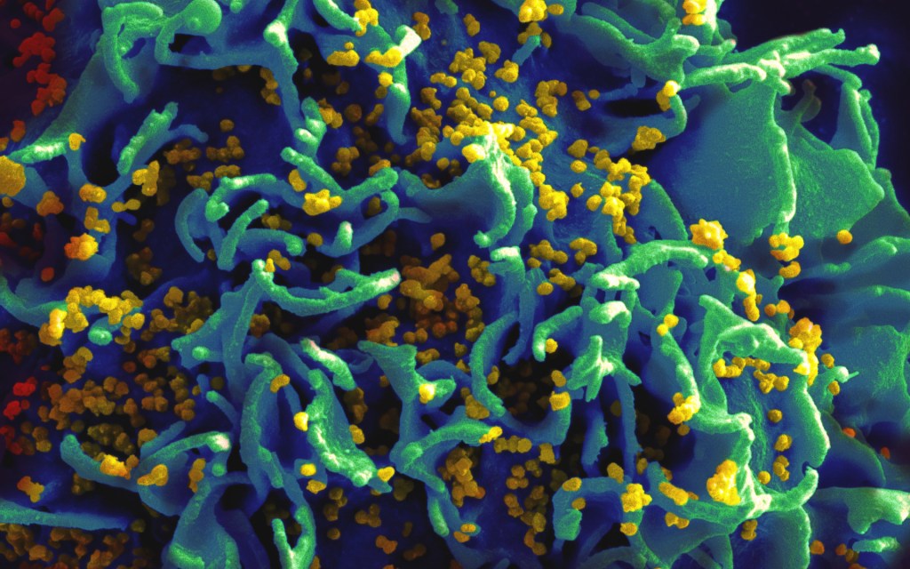 Une cellule infectée par le VIH. // Source : Wikimedia/CC/National Institutes of Health (photo recadrée)