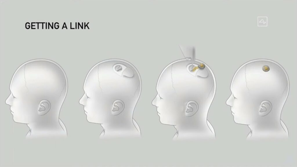 La chirurgie pour insérer la puce de Neuralink se veut peu invasive, d'après les descriptions fournies par Elon Musk. // Source : Neuralink