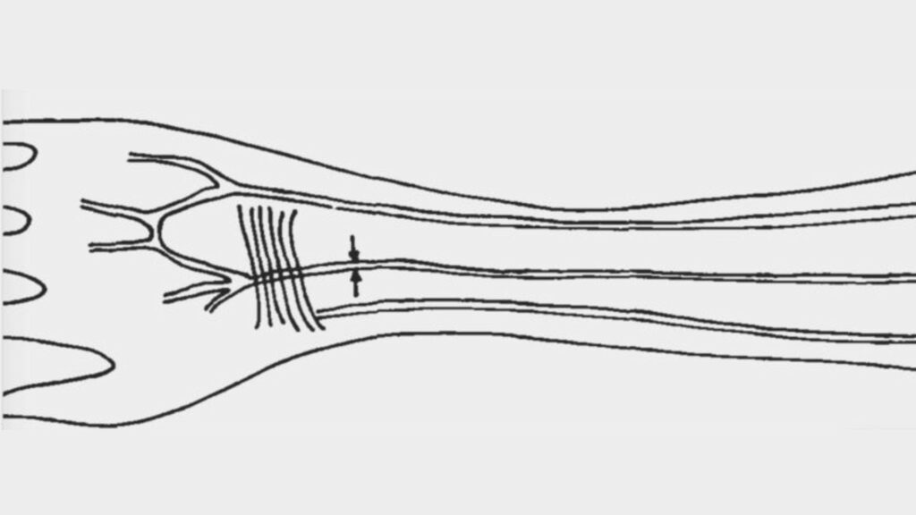 Au milieu, désignée par les deux petites flèches, l'artère médiane (car au milieu des deux autres artères). // Source : Pr Maciej Henneberg / Flinders University