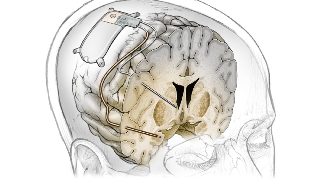 Implant cérébral personnalisé contre la dépression résistante. // Source : UC San Francisco (UCSF)
