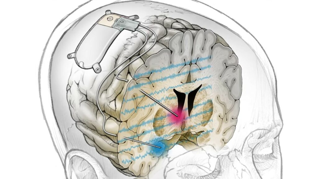 L'implant déclenche une stimulation cérébrale personnalisée lorsque les biomarqueurs liés à la dépression du patient se déclenchent. // Source : UC San Francisco (UCSF)