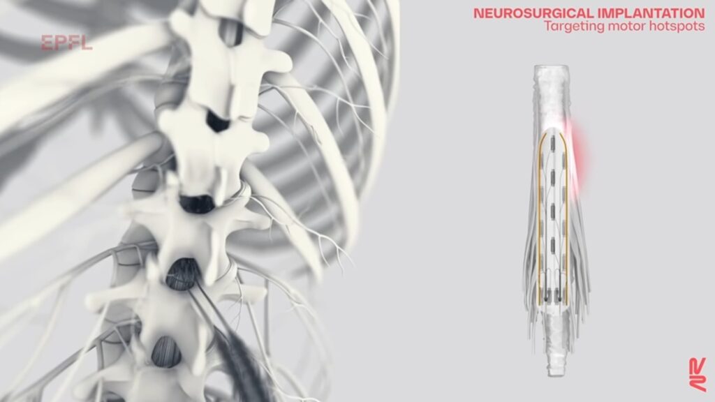 Les implants viennent réactiver des neurones spécifiques en fonction de la tâche. // Source : NeuroRestore