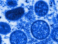 Micrographie électronique de particules de virus de la variole du singe isolés en 2003 aux États-Unis, dans des échantillons humains  // Source : The Conversation / Cynthia S. Goldsmith, Russell Regner / CDC / AP