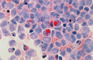 Source : National Cancer Institute