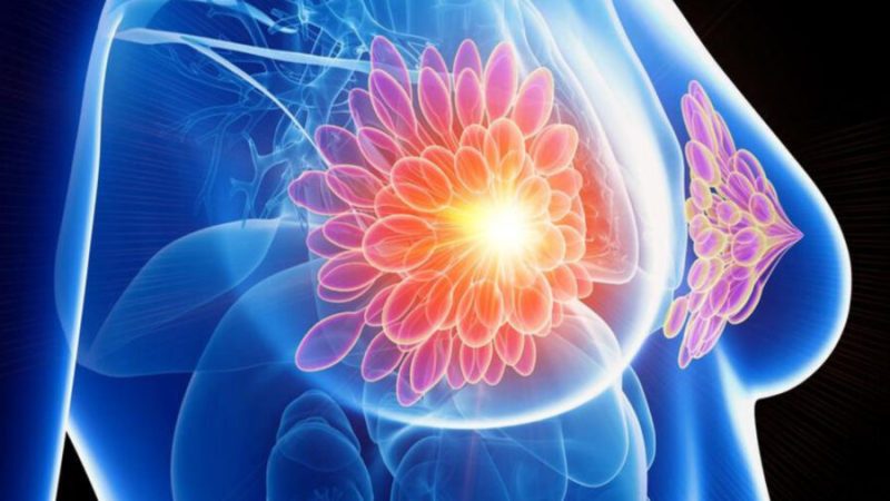 Détecter un cancer du sein 5 ans avant les symptômes : c’est déjà possible