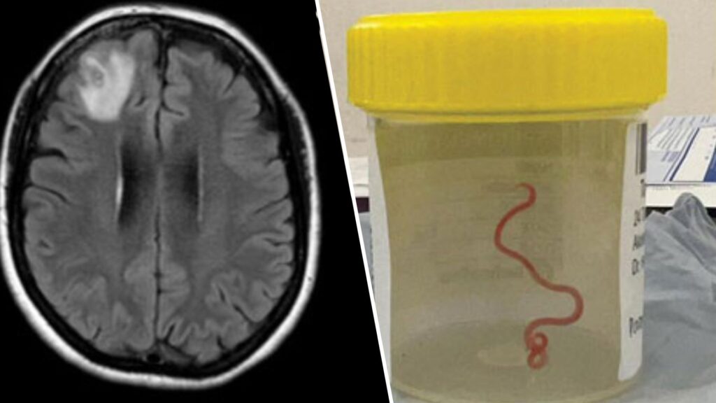 The lesion in the brain, caused by the worm.  On the right, the worm, in a jar, after extraction.  // Source: Hossain et al., Emerging Infectious Diseases, 2023